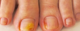 The main symptoms and the picture of onychomycosis
