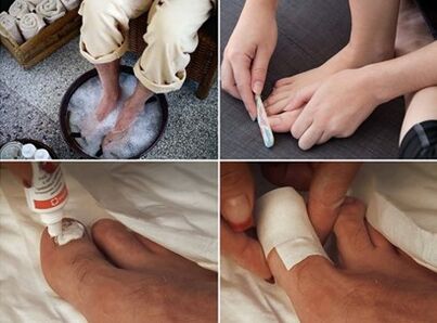 Steaming the feet and applying urea cream on the nails affected by fungus
