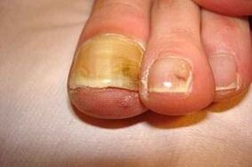 careless toenail fungus
