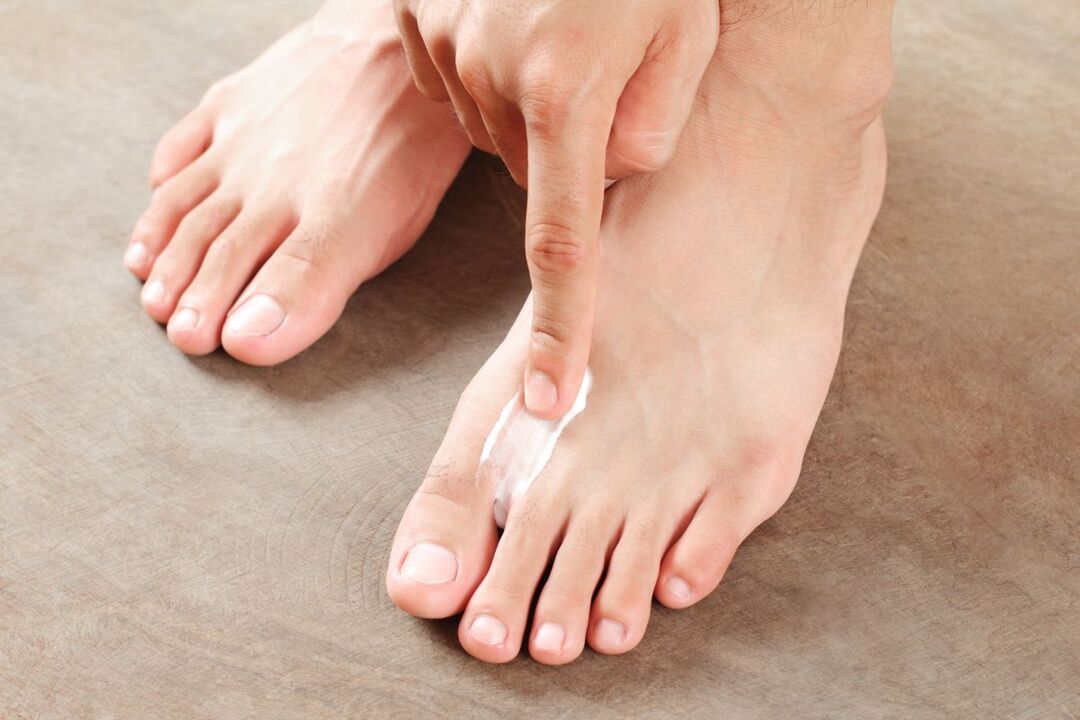 treating foot fungus with ointment