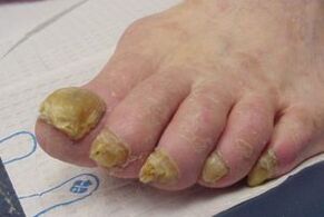 Symptoms of toenail fungus