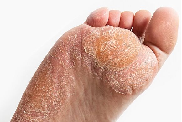 peeling skin when infected with a fungus