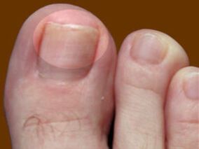 Toenail fungus an indication for the use of fungicidal drops