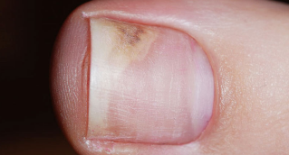 The symptoms of the initial stage of onychomycosis
