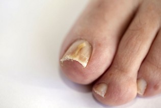 fungus in the nails of the feet