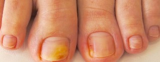 fungus in toenails symptoms