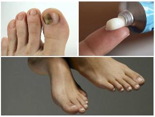 nail fungus on legs treatment