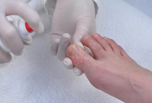 The treatment of the execution of nail fungus