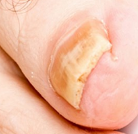 The finger nail affected by the fungus