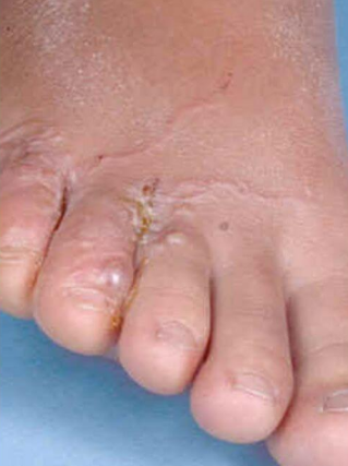 Fungus between the toes of
